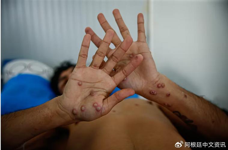 阿根廷今年已确诊78例猴痘病例