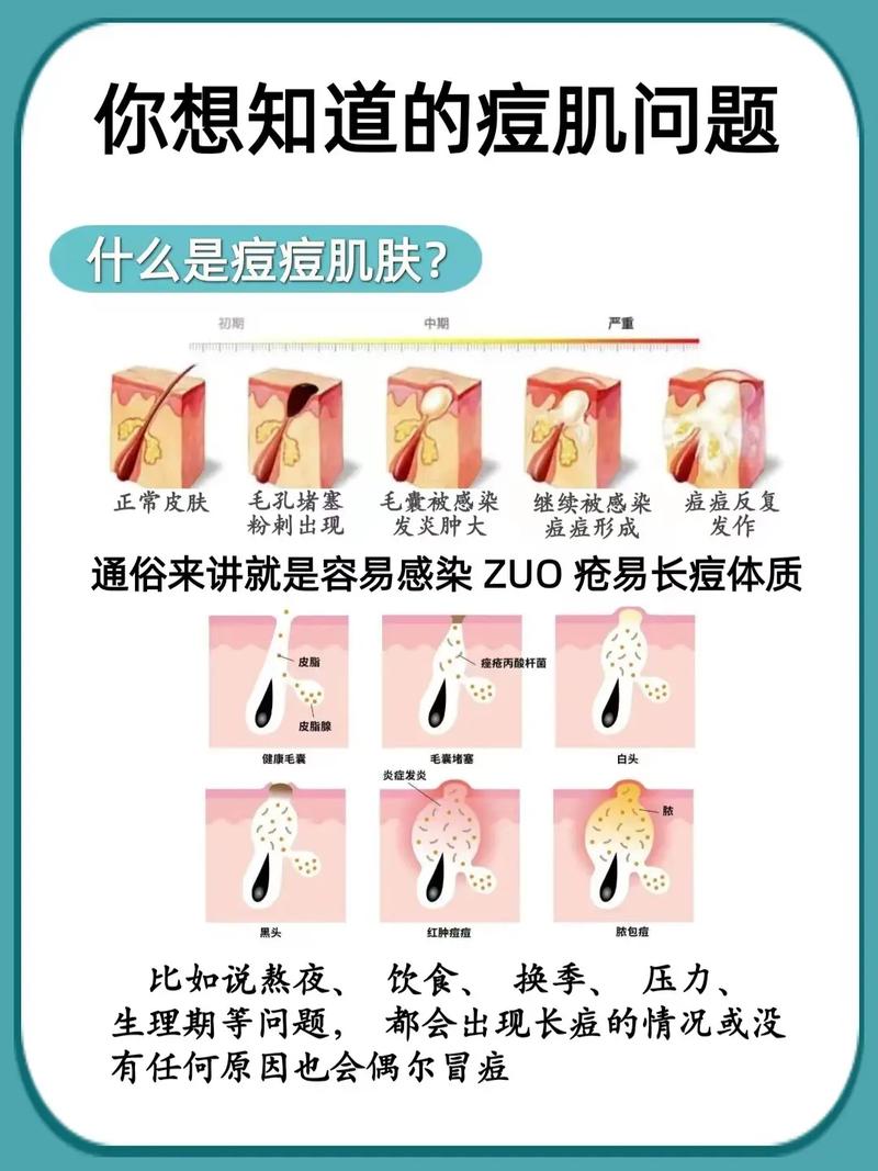 青春期长痘更容易留下痘印！改善青春痘做好10件事