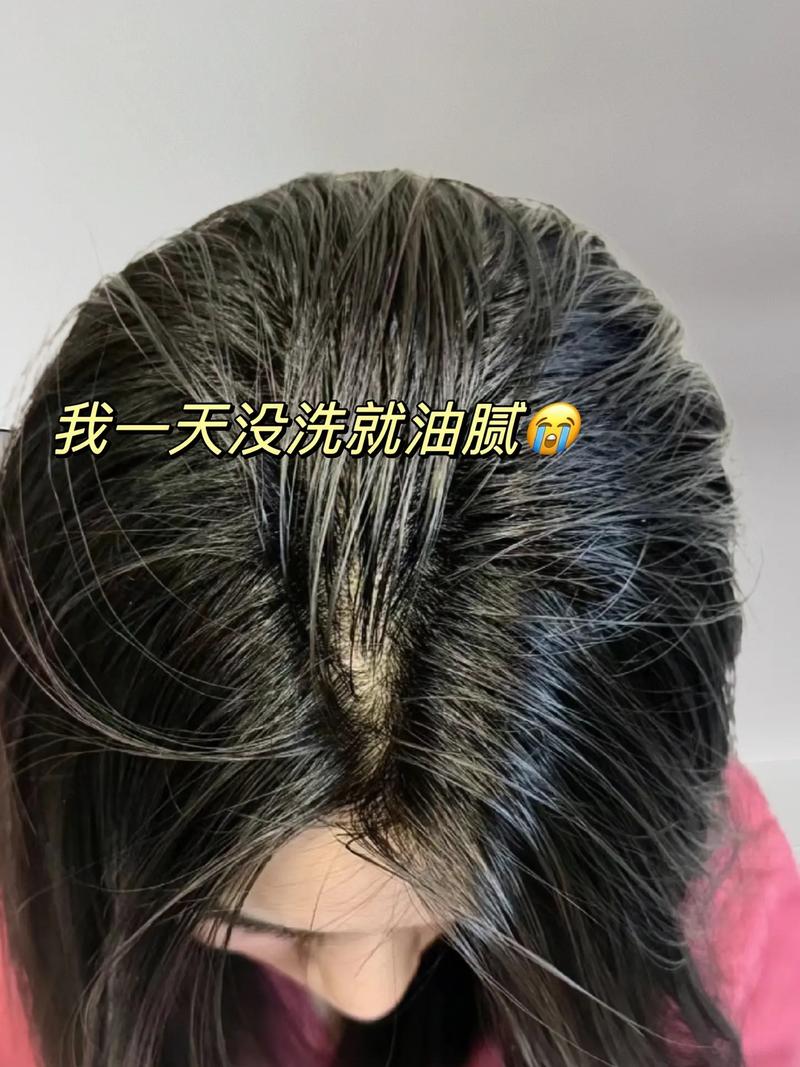 网友:“大油头”、头皮屑、脱发,全齐了……专家:解决办法如下→