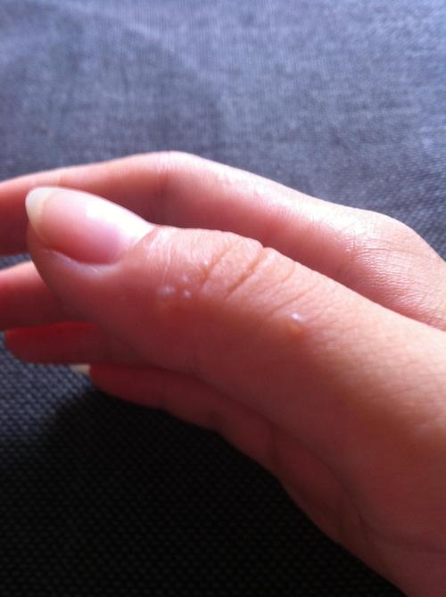 夏季手上反复生长的小水泡,中医这样治疗!